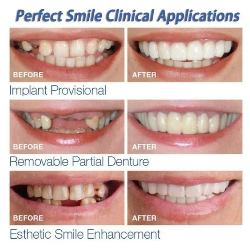 طقم قشرة أسنان قابلة للتركيب،  - مراجعة Teeth Whitening Kit وسعره